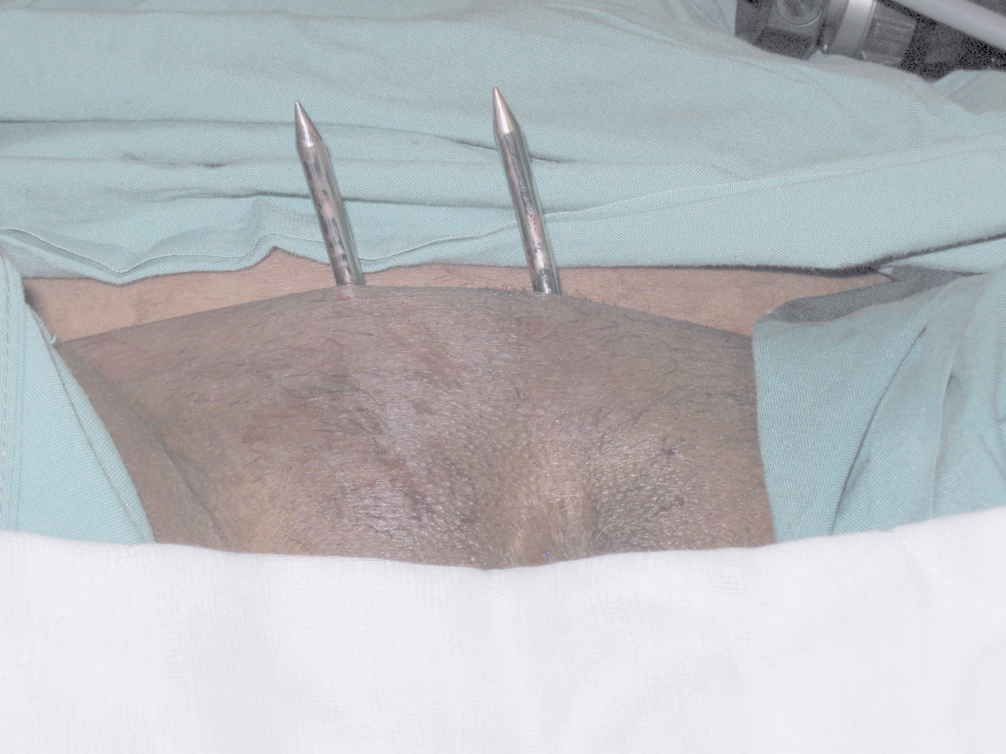 Tension Free Vaginal Tape Needles In-Situ Serag Youssif Tension Free Vaginal Tape Needles In-Situ Serag Youssif